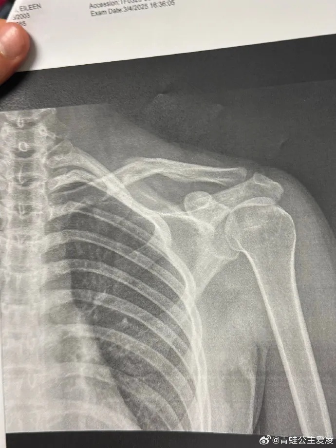 摔倒造成了, img